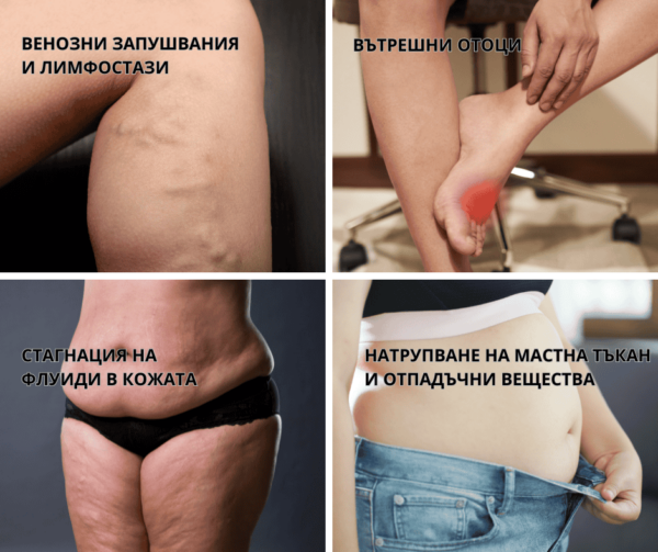 Резултат от целулита